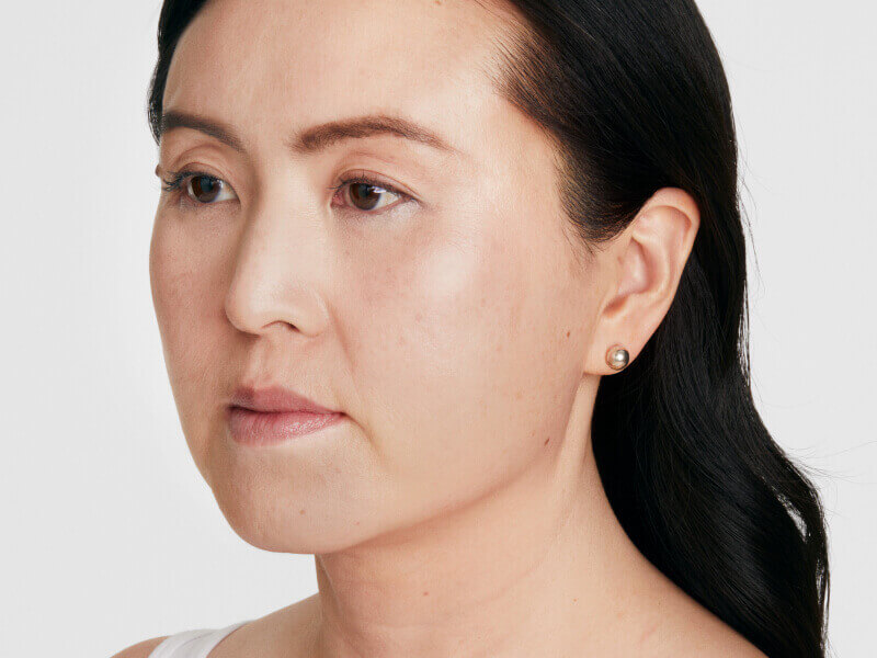 Before-and-after front view demonstrating facial skin tightening and lifting with Ultherapy® ultrasound technology