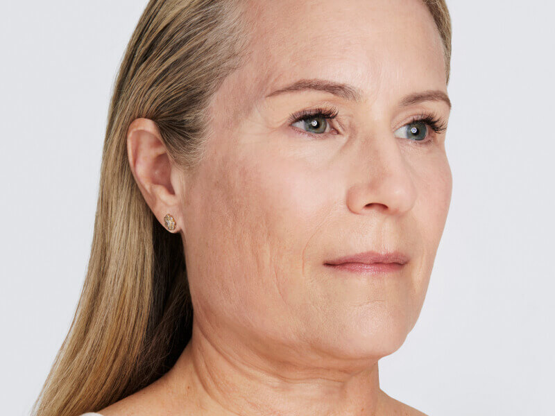 Before-and-after skin lift of the face after Ultherapy® treatment