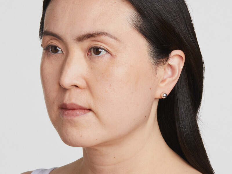 Before-and-after front view demonstrating facial skin tightening and lifting with Ultherapy® ultrasound technology