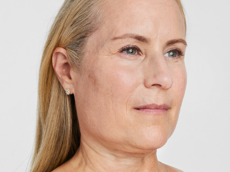Before-and-after skin lift of the face after Ultherapy® treatment