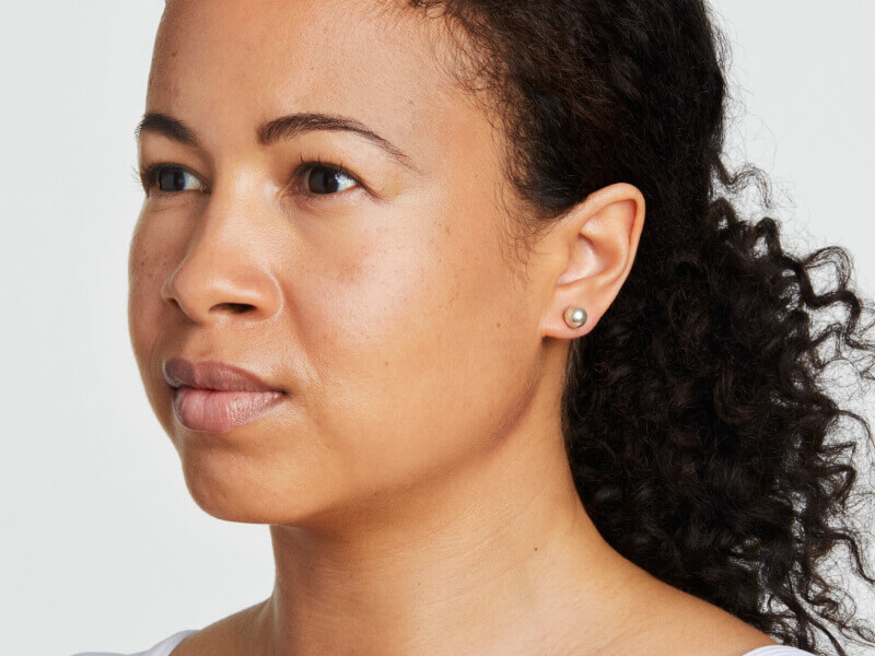 Before-and-after side view showing facial lifting and jawline definition with Ultherapy® non-invasive ultrasound treatment