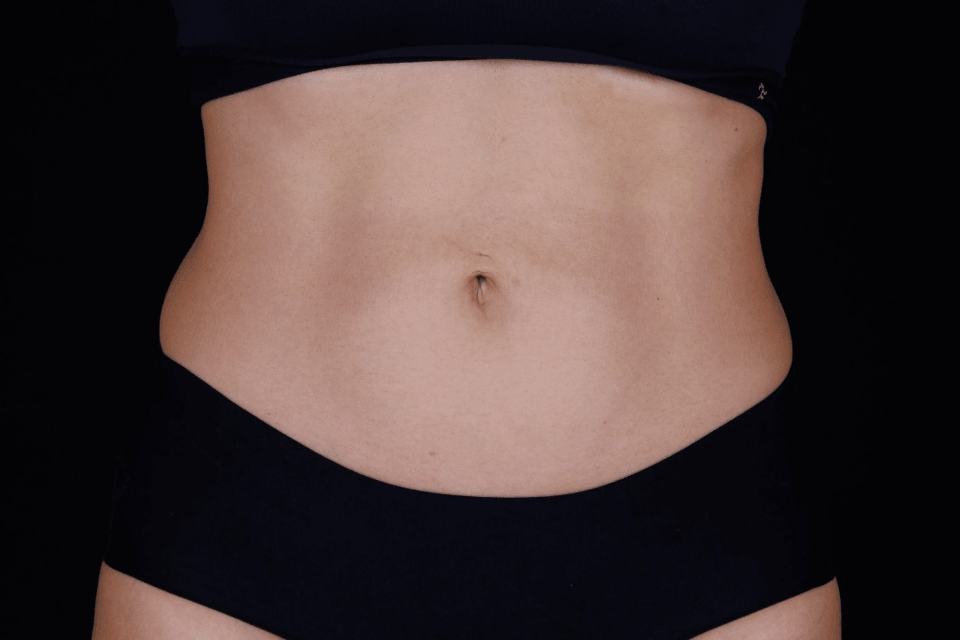 Before-and-after abdomen skin firming with Ultherapy PRIME® non-invasive ultrasound treatment