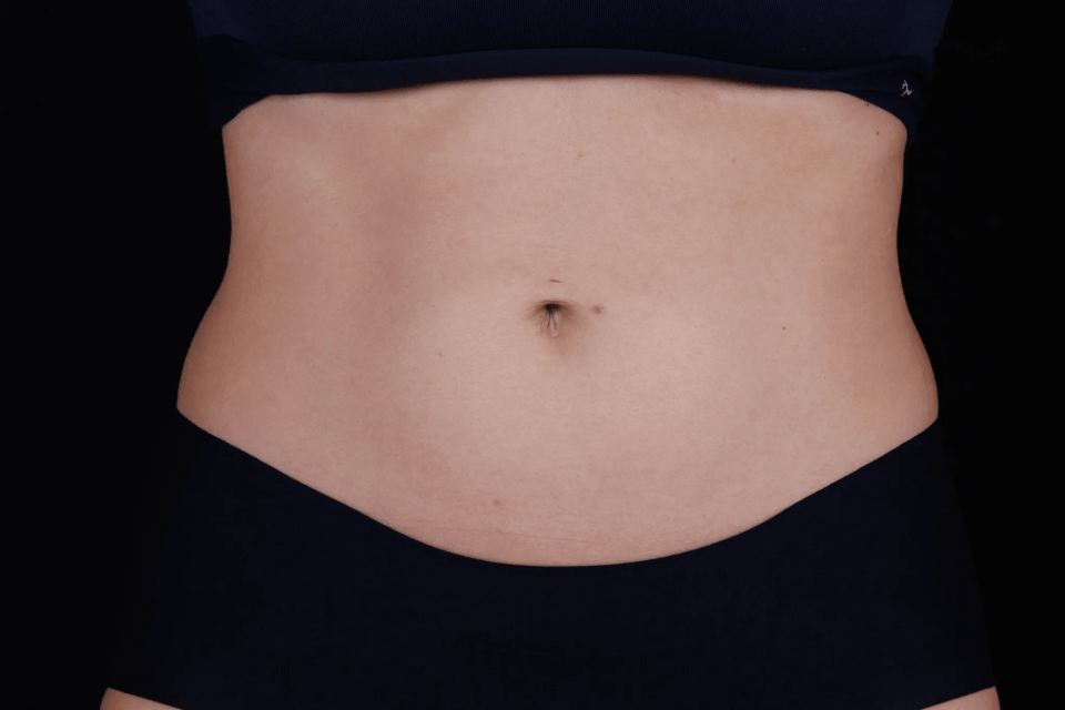 Before-and-after abdomen skin firming with Ultherapy PRIME® non-invasive ultrasound treatment